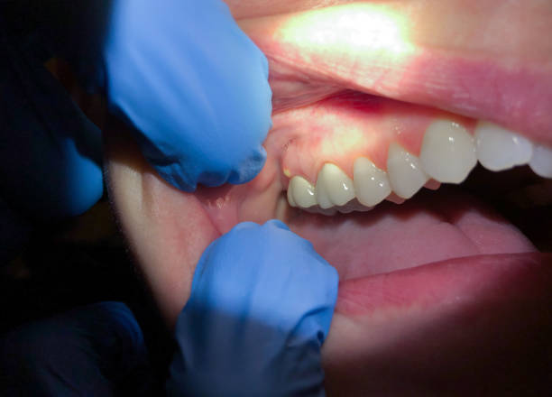 Best Urgent Care for Lost Fillings or Crowns in Laurium, MI